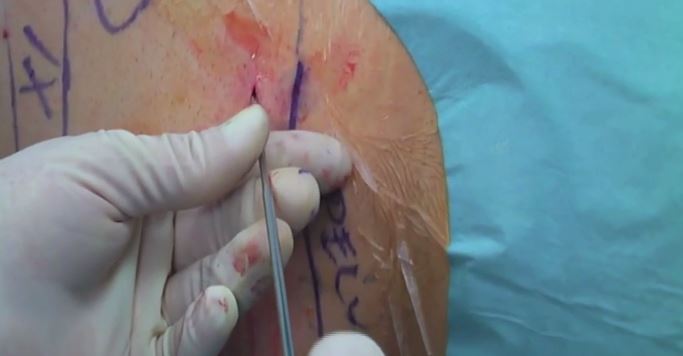 PCNL